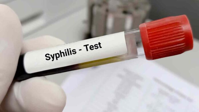 Casos-de-sifilis-en-adultos-aumentaron-en-las-Americas-1